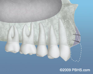 Bonegraft treatment